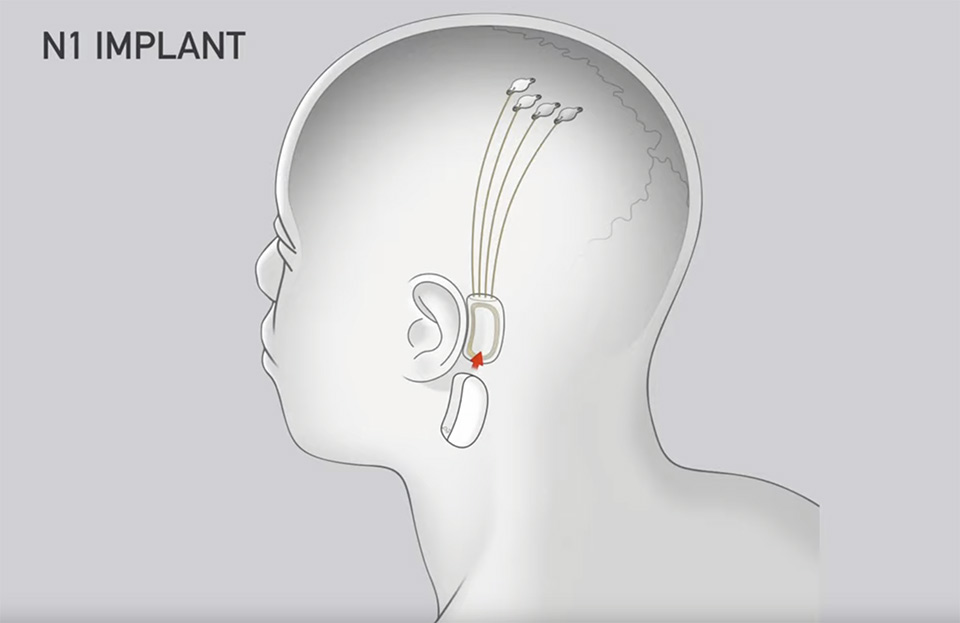 Neuralink N1 implantaat